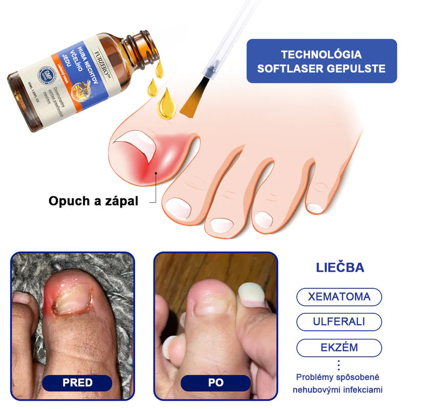 Bee Venom for Nail Fungus: A Complete Solution to Nail Fungus & Growth (BUY 1 GET 1 FREE)